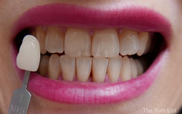 Teeth Whitening Malaysia