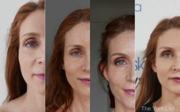 Vampire Facial KL Before & After Photos