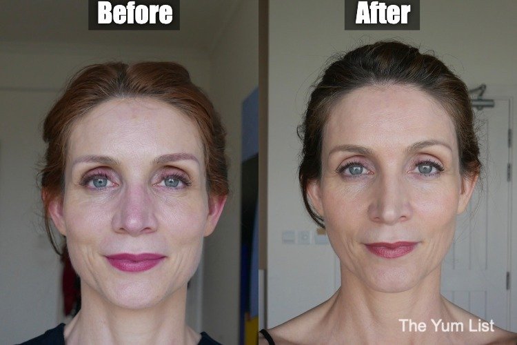 PicoWay & Fractional RF Micro-Needling
