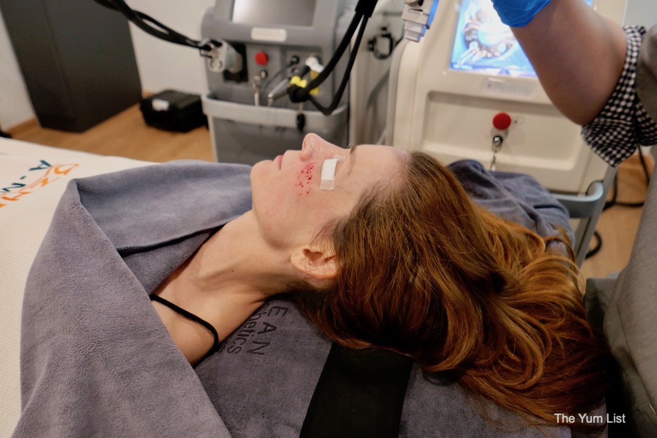 PicoWay & Fractional RF Micro-Needling