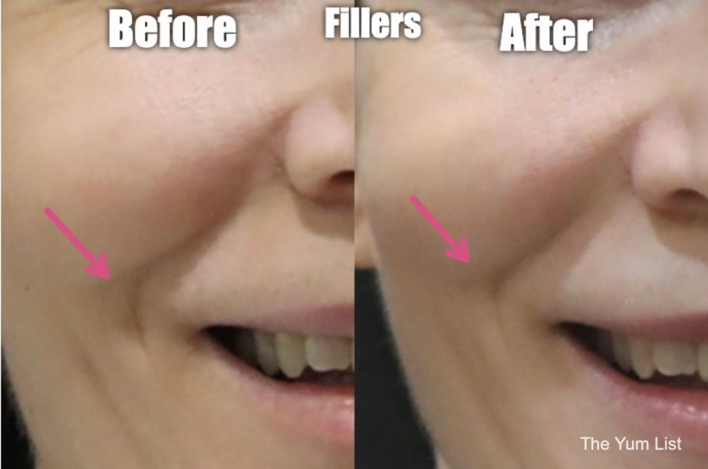 Before & After Fillers Kuala Lumpur