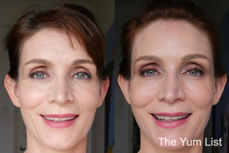 Looking My Best in 2021 Botox Fillers Laser