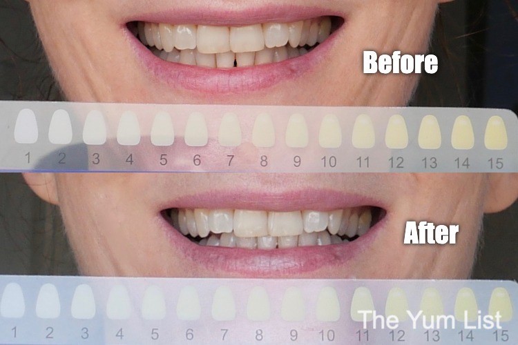 Home Teeth Whitening Malaysia