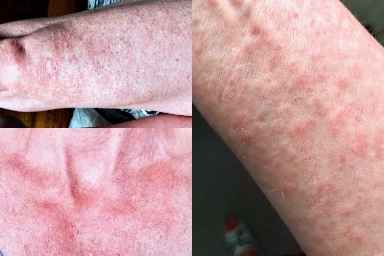 Rash from Chikungunya