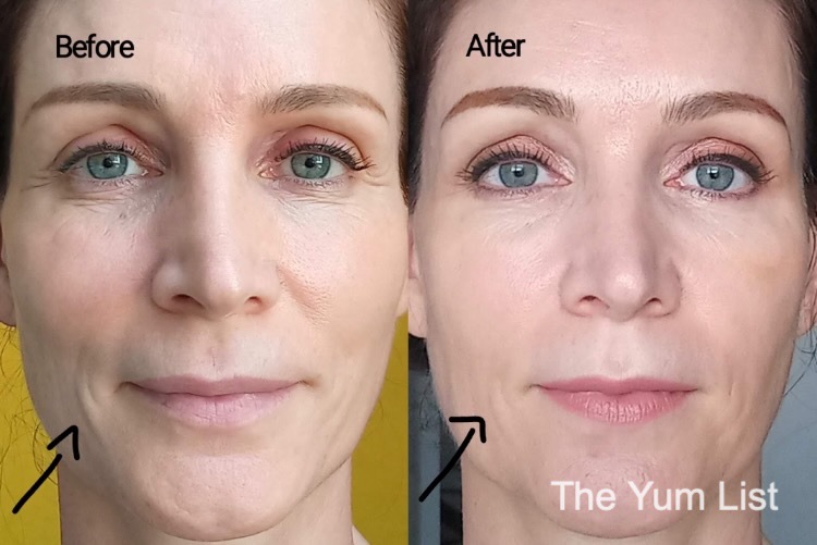 Before & After PDRN
