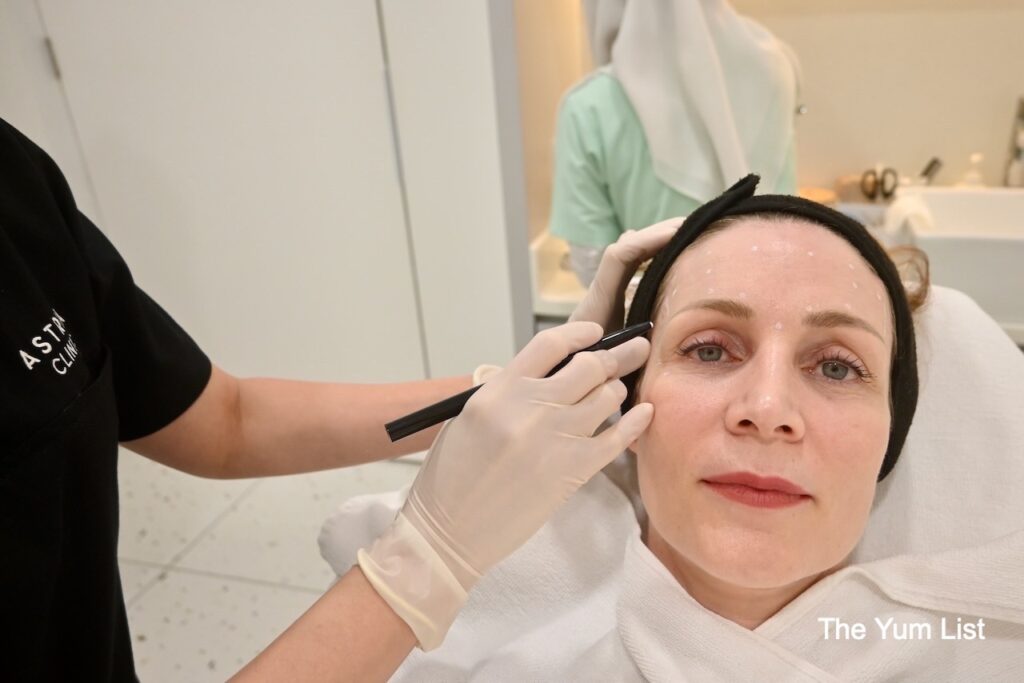 Botox alternative Marking My Face For the Planned Injection Sites